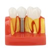 Dental Implant Teeth Model, Dental Implant Analysis Crown Bridge Model,