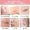 傷跡ケアテープ ケロイド テープ 傷あとケア用シリコンジェルシート 手術後 帝王切開 傷テープ 傷隠しテープ
