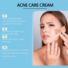 Acne Control Cream for Face,Acne Treatment Gel,A-cne Treatment,A-cne Face Cream,Ac-ne