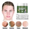 Crema De Tratamiento De Acné Con Ginseng Para Eliminar Las