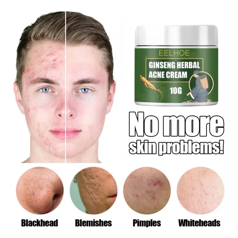 Crema De Tratamiento De Acné Con Ginseng Para Eliminar Las