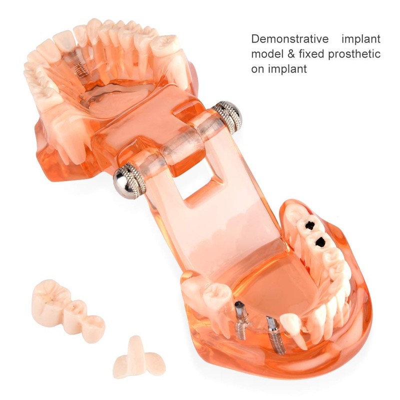 Dental Model Dental Model, Removable Dental Implant Teaching Model Dentist