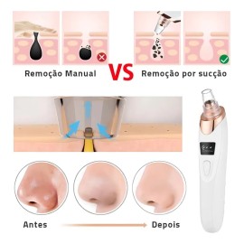 Eliminador De Puntos Negros Succionador Espinillas Aspirador