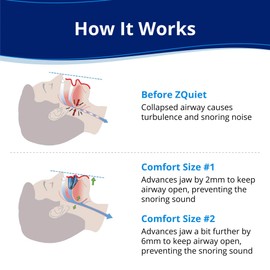 ZQuiet ZQuiet, Anti-Snoring Mouthpiece (Blue) + Cleaner (1.5oz Bottle), Starter Pack with 2 Sizes, Made in USA, BPA-Free, Medical-Grade Material
