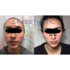Spaesthetic Tratamiento Antiacne