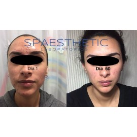 Spaesthetic Tratamiento Antiacne