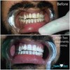 Crystal Clear Teeth Whitening Kit de Gel Blanqueador de Dientes