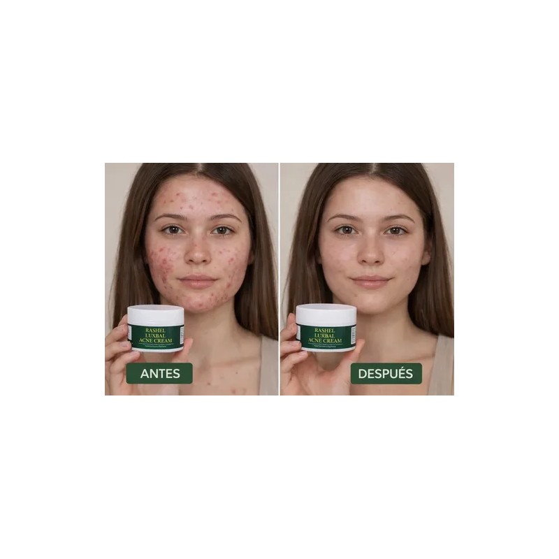 Crema Herbal Tratamiento Acné, Control Grasa, Minimiza Poros