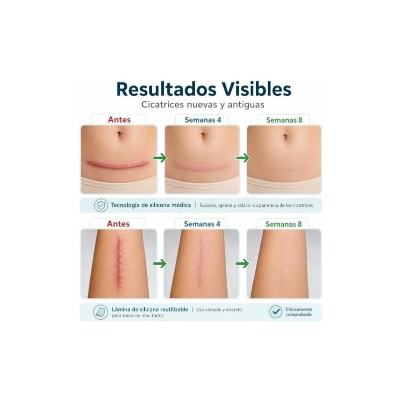 Parches Silicona para Cicatrices – Láminas Reutilizables para Cesárea y