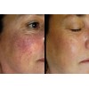 Vitamin K Cream - Eliminate Spider Varicose Veins Rosacea Capillaries