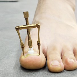 Ingrown toenail corrector ingrown toenail self-treatment tape band set RX-55 / 내성발톱 교정기 내향성발톱 자가치료 테이프 밴드 세트 RX-55