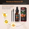 Aceite De Batana For El Crecimiento Del Cabello Con