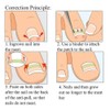 Young21 Ingrown Toenail Straightening Clip Curved Bs Brace Toenails Thick