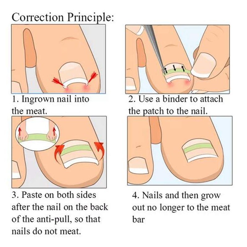 Young21 Ingrown Toenail Straightening Clip Curved Bs Brace Toenails Thick