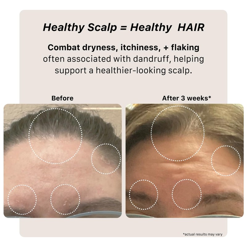 ACTIIV Remedy Dandruff Shampoo Treatment | Relieves Dryness & Flakes,