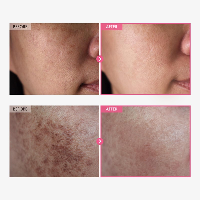 TOSOWOONG Arbutin 7% + Tranexamic Acid 4% Cream, 70,000ppm Arbutin,