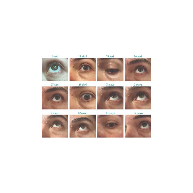 Tagoff Remueve Naturalmente Verrugas Sin Dolor Ni Cicatrices