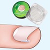 10 Pcs Ingrown Toenail Correction Strips Brace Kit, Ingrown Toenail