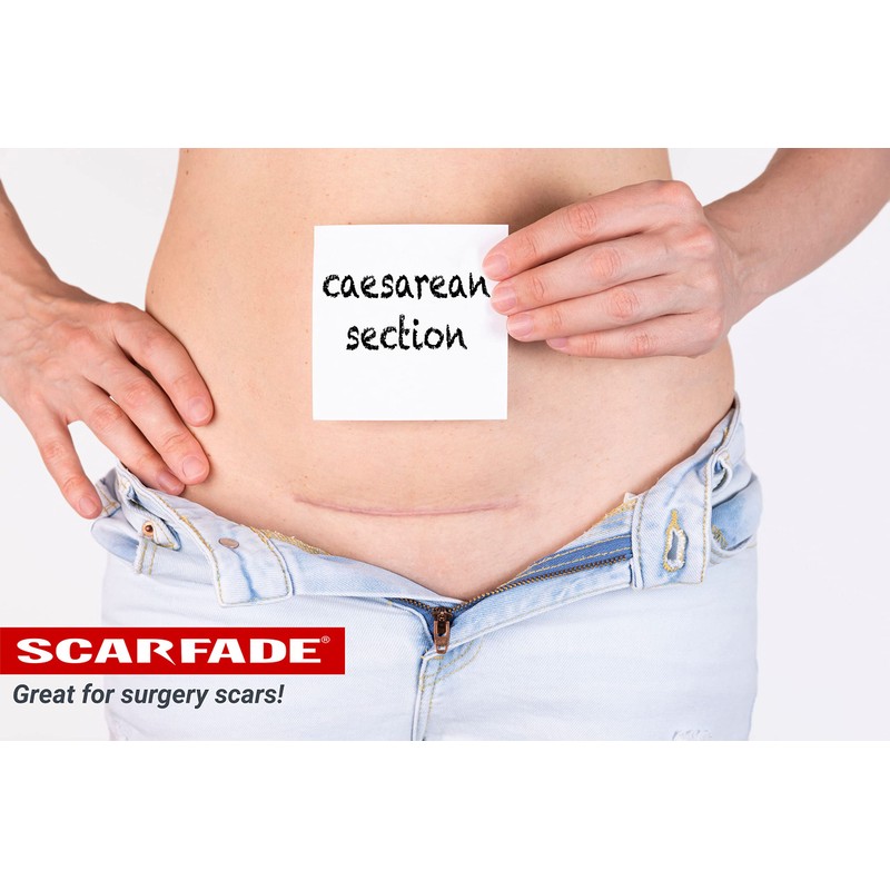ScarFade Elite Advanced Scar Treatment, Scar Removal, Scar Therapy, Scar