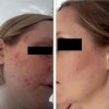 Kit 2 En 1 Aclarante Facial. Elimina Manchas Y Acné