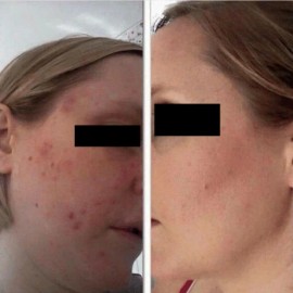 Kit 2 En 1 Aclarante Facial. Elimina Manchas Y Acné