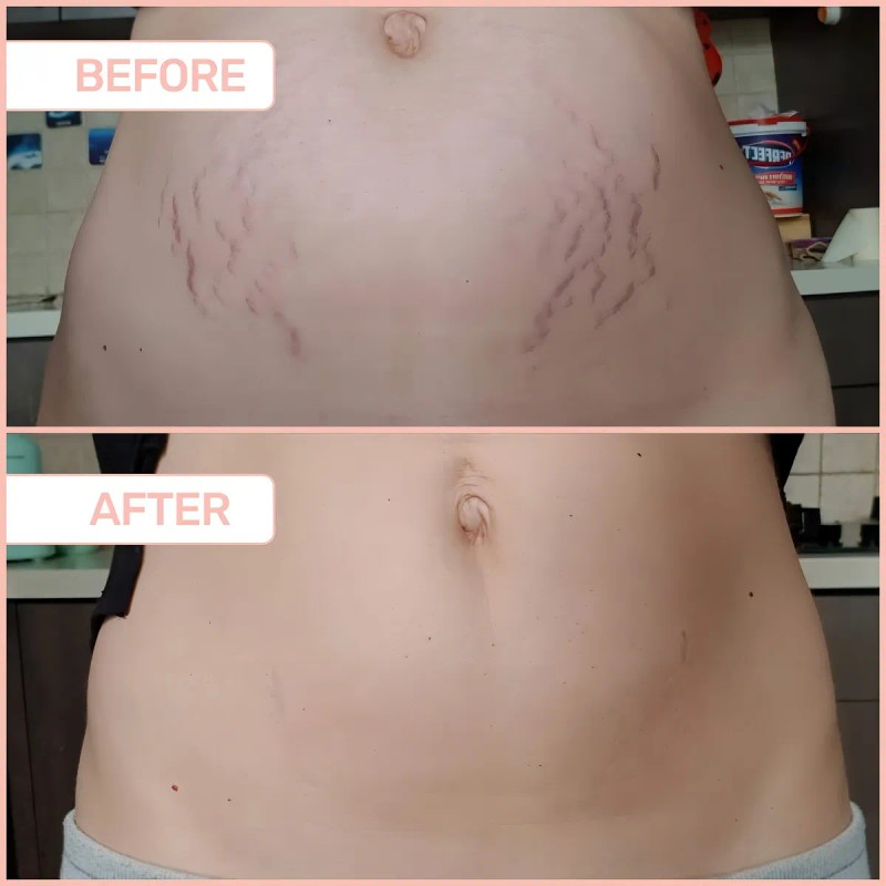 B-flat Crema Reafirmante Para Estras De Celulitis, Tratamien