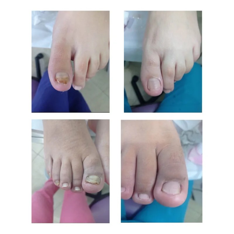 Fungicida P/ Uñas C/ Hongos, Negras, Amarilla U Onicomicosis