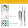 Pimple Blackhead Remover 3-Piece Tweezers Face Nose Black Head Precise