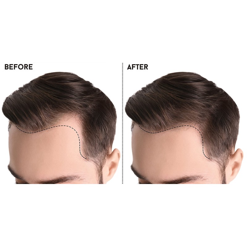 KHENZ Tea Tree Shampoo 1000 ml prevents hair from falling