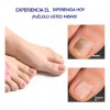 Parches Antimicóticos For El Tratamiento De Uñas