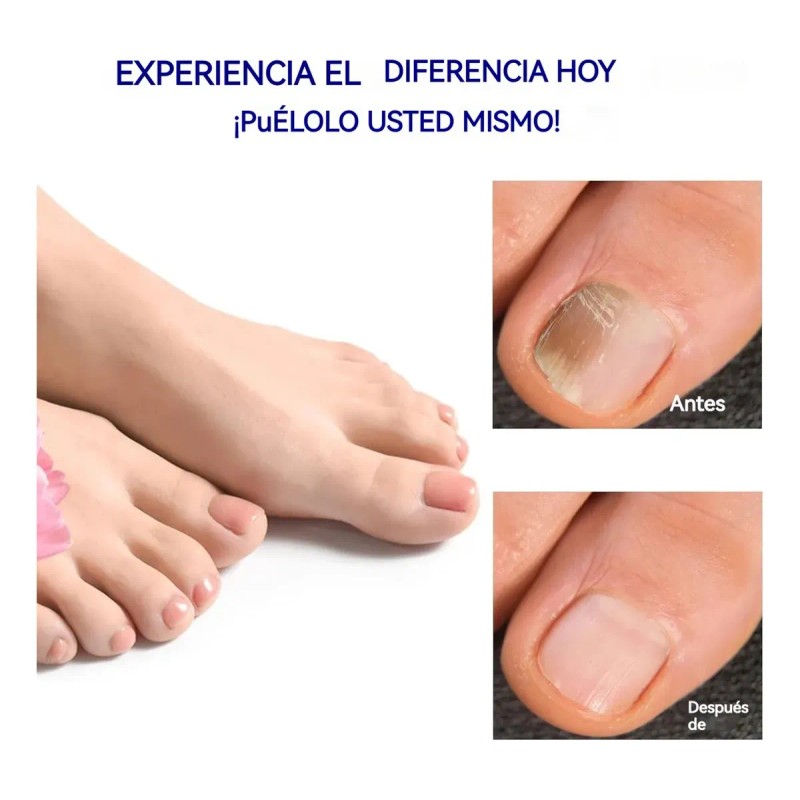 Parches Antimicóticos For El Tratamiento De Uñas