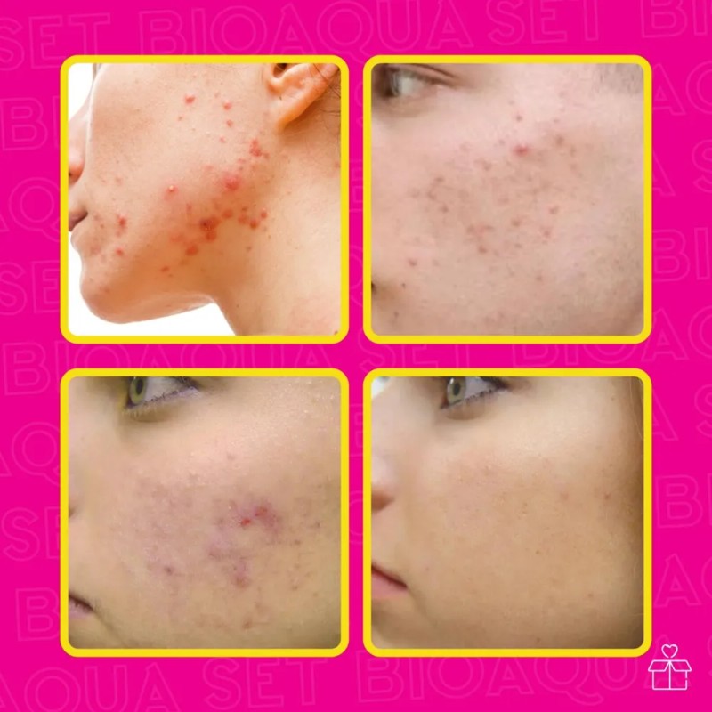 Set De 3 Pure Skin Bioaqua Retira Acne Espinillas Grasa