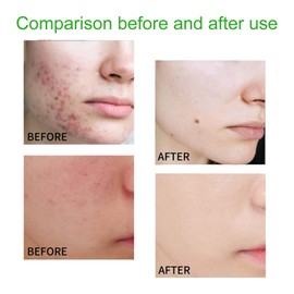 Anti Pimple Facial Cleanser, Lavado de Espuma for el Acné, which exfoliates the skin and fights impurities caused by the accumulation of dead skin, Salicylic Acid Cleanser