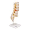 3B Scientific A76/5 Lumbar Spinal Column with Dorso-Lateral Prolapsed Intervertebral