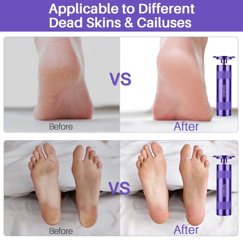 Electric Foot Callus Remover, 2-in-1 Electric Foot Filer/Nail Filer, Callus