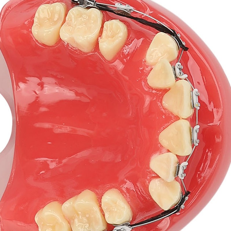 Professional Dental Demonstration Orthodontic Model with Metal Wires and Bracket