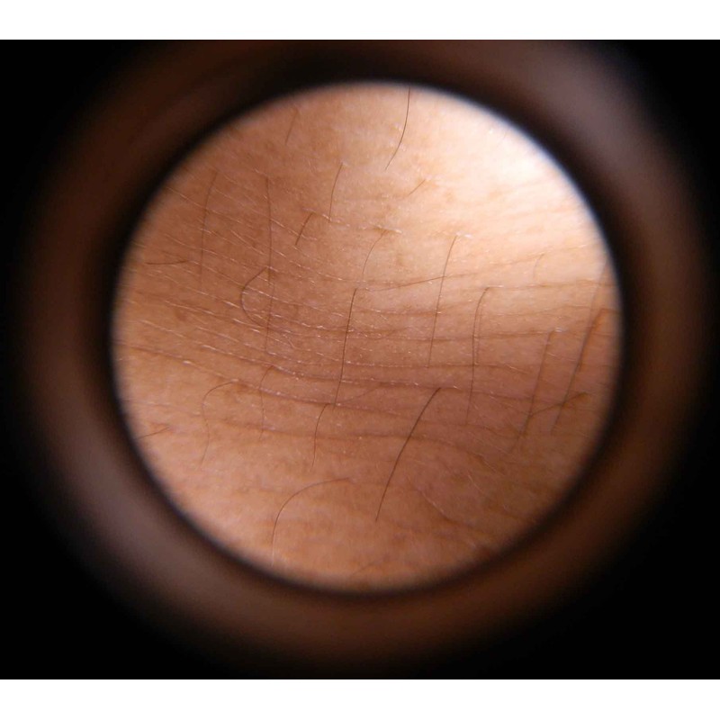 Cross Canada 11-050 LED Dermatoscope Diagnostic Set