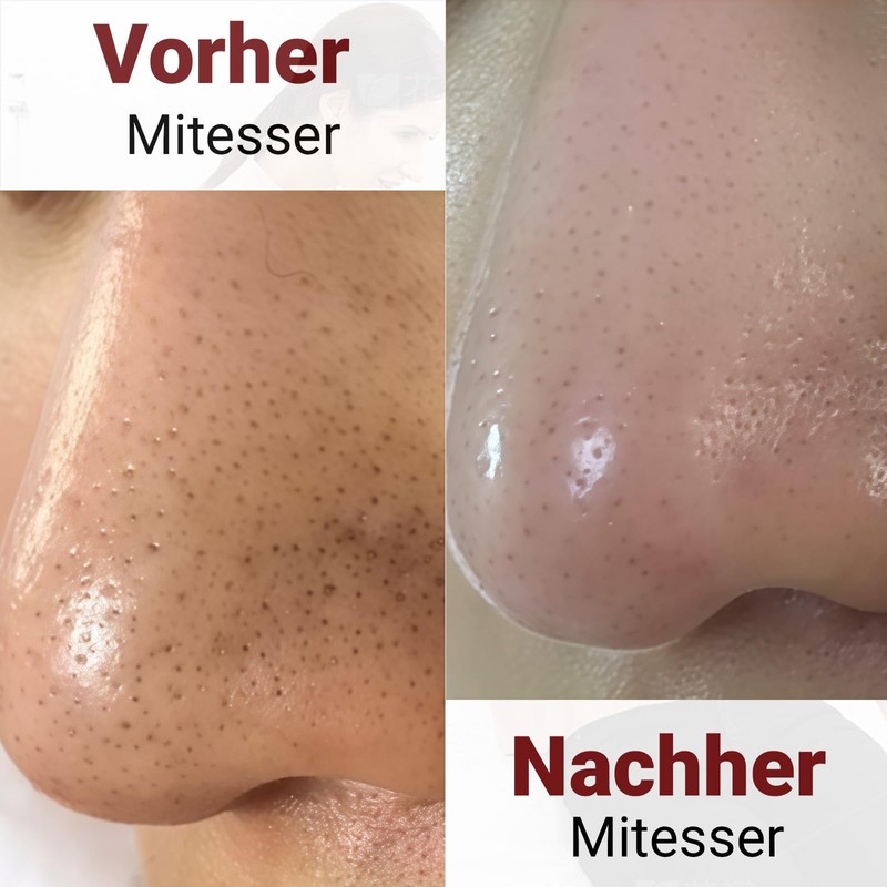 Diffaxy 2-teiliges Pickel Werkzeug, rutschfestes Gewinde, Edelstahl-Mittesserentfernerfür Hautunreinheiten, Akne und