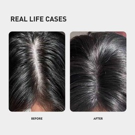KINTOR Producto Para El Crecimiento Y Engrosamiento Del Cabello Con Kx-826 Dht Al 0.5%, Esencia De Extracto Vegetal, Solución Anticaída, Laca Para El Cabello, Control De Grasa En 3 Días, Reducción De