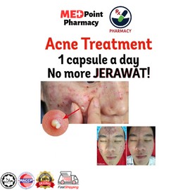UBAT JERAWAT TREATMENT MUKA & BADAN BERKESAN - SEPAPAN