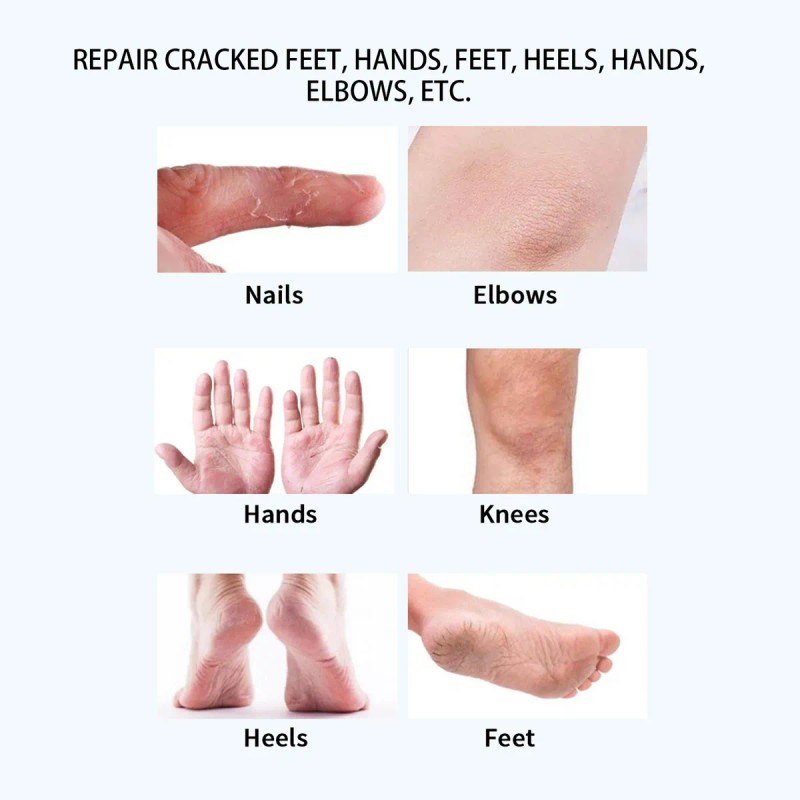 Lanthome Crema De Urea Crema Removedora De Callos De Pies