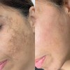 Mascarilla Facial Ácido Hialuronico