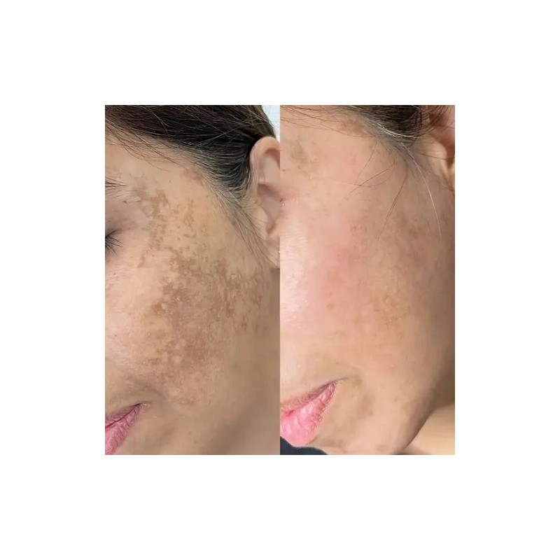 Mascarilla Facial Ácido Hialuronico