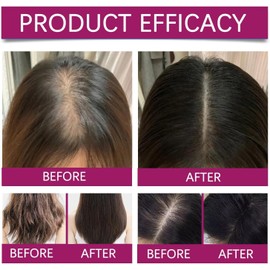 Esencia Para El Cuidado Del Cuero Cabelludo Con Biotina Y Cebolla, Hidrata Profundamente Y Fortalece El Cuero Cabelludo SéRum Capilar Biotina Y Cebolla Roja 20 Viales Individuales De 1,5 Ml (1 BOX)Dur