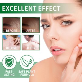 Anti Acne Cream,Anti-Acne Removal Cream for Teenagers,Acne Face Cream with Tea Tree,Reduce Acne & Soothing Acne,Natural Anti Acne Face Cream for Women & Men