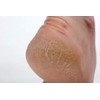 100% Natural Healing Tea Tree Ointment: for nail infections, athletes
