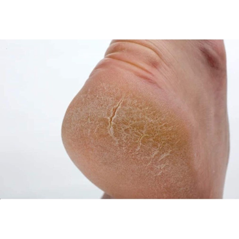 100% Natural Healing Tea Tree Ointment: for nail infections, athletes