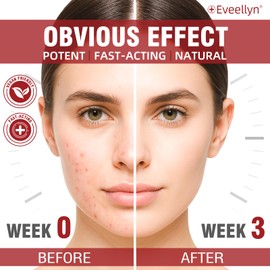 Acne Treatment Cream, Spot cream for Oily and Combination Skin, Visible Results in 21 Days, Blackhead Prevention, Gentle Fragrance Free Formula 35g