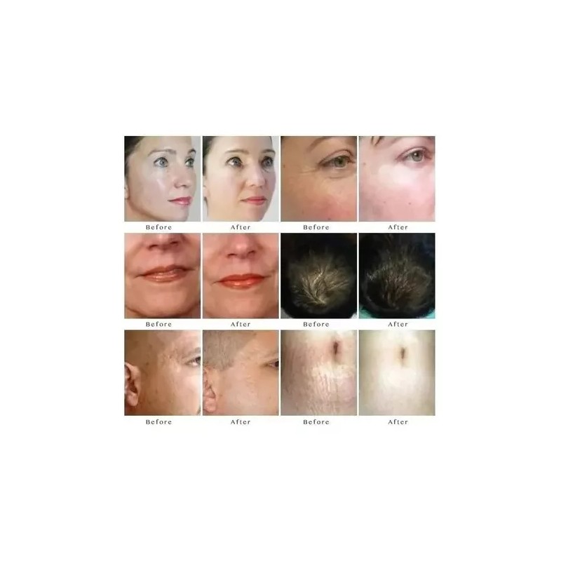 E-karly Derma Roller Facial Barba Titanio Regenera