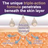 Crema De Silicona Para Cicatrices En Gel: Tratamiento Avanzado Para